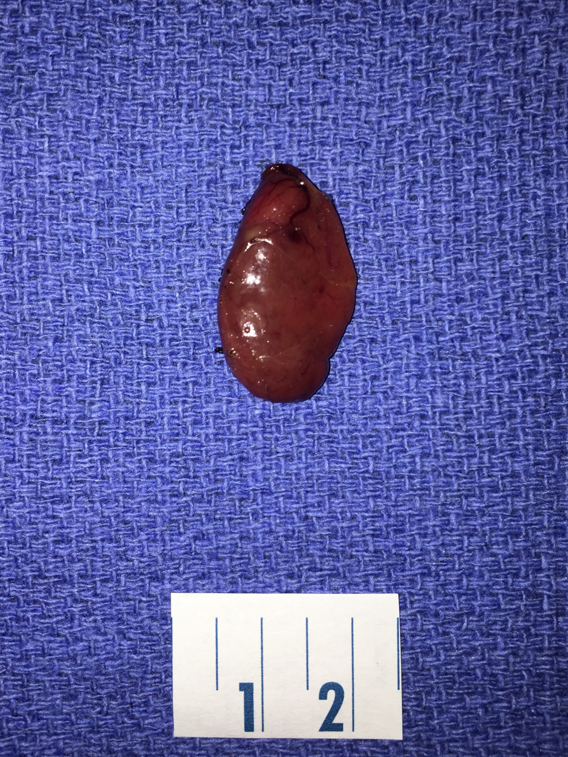 Parathyroid Surgery Atlanta Advanced Ent Allergy Sinus Sleep