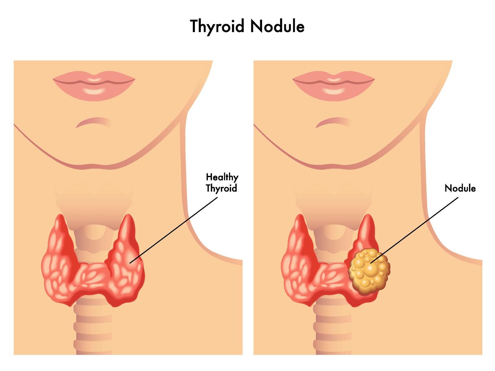 Thyroid nodule treatment