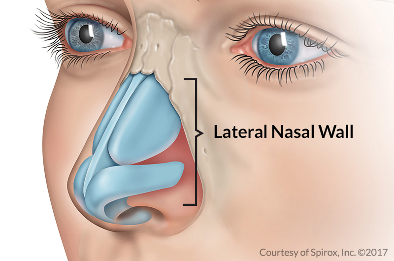 Nasal Valve Collapse Treatments Atlanta Nasal Obstruction Treatments Atlanta