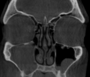 Acute sinusitis on CT