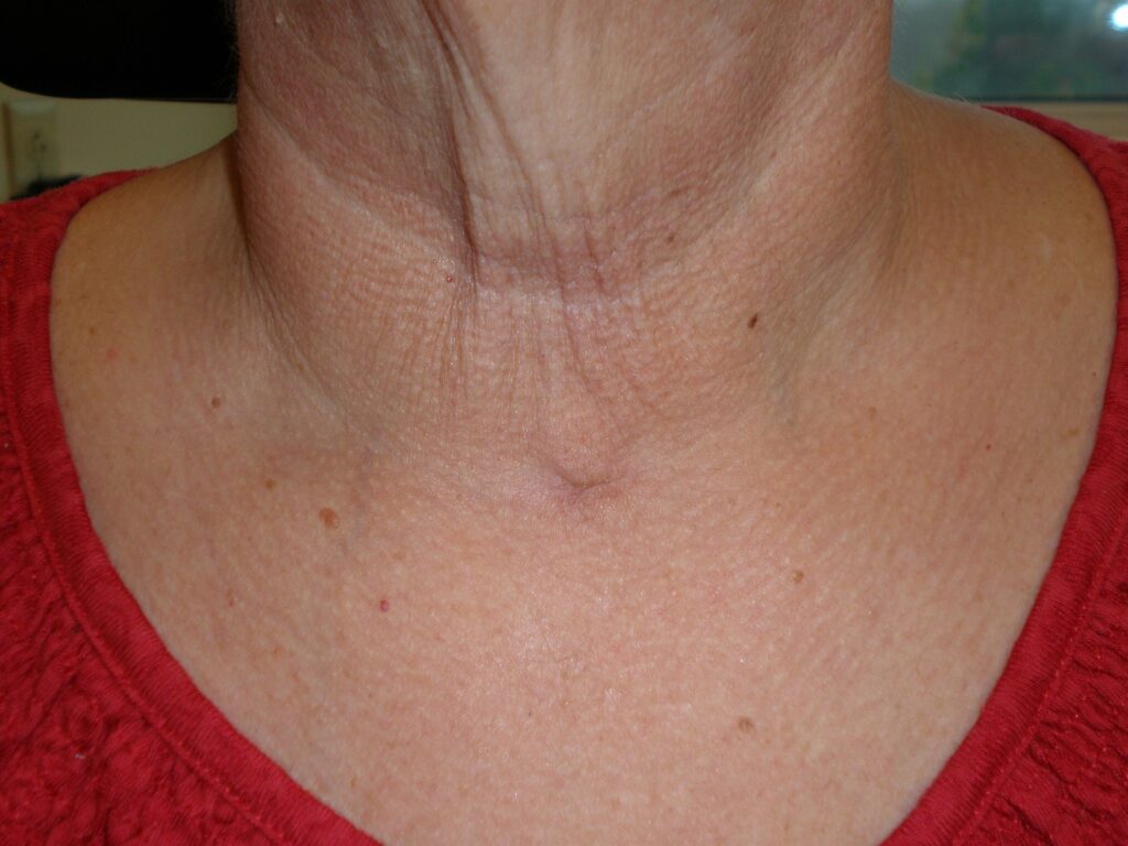 Minimally Invasive Thyroidectomy Atlanta Advanced Ent And Allergy
