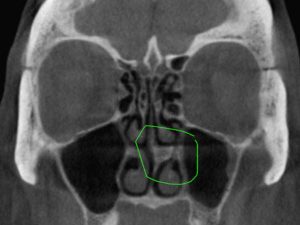 deviated septum xray