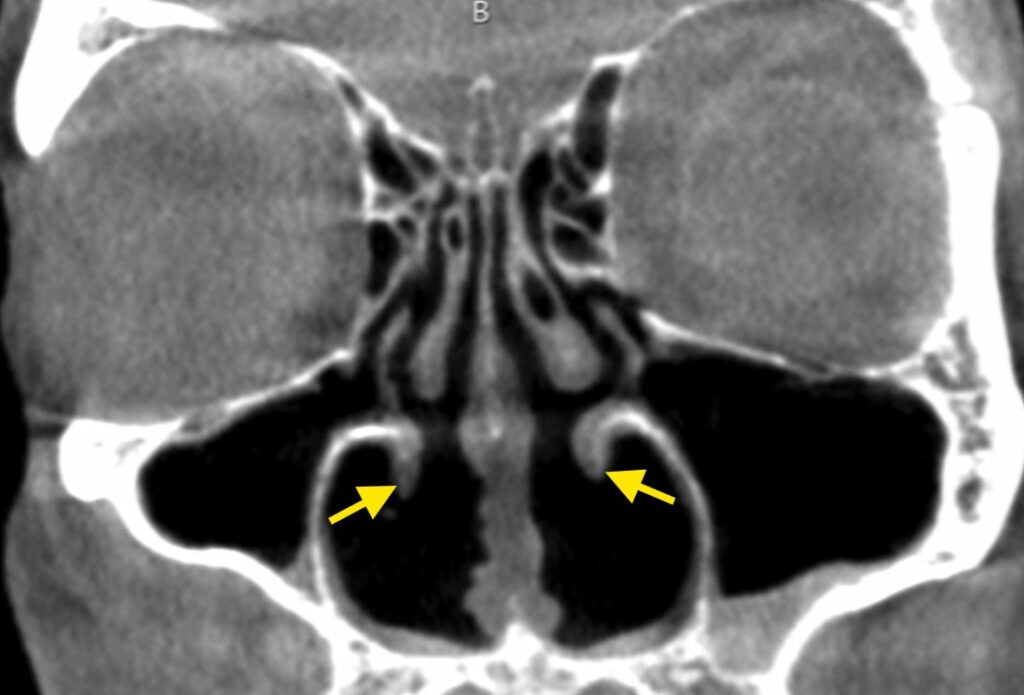 CT Scan showing post-op turbinate resection and findings typical of empty nose syndrome