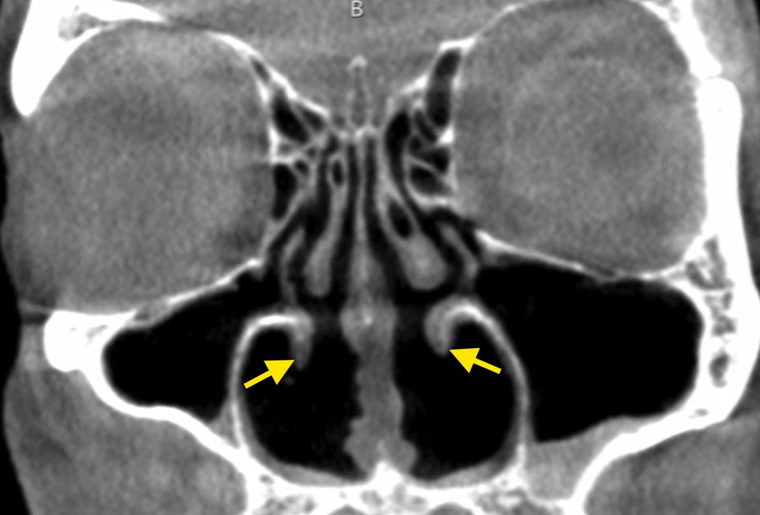 Understanding Empty Nose Syndrome - Advanced ENT & Allergy | Sinus ...