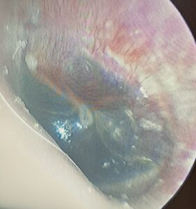 Hemotympanum ear pressure