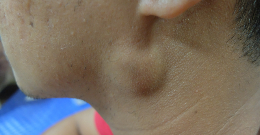 cancerous cyst on neck