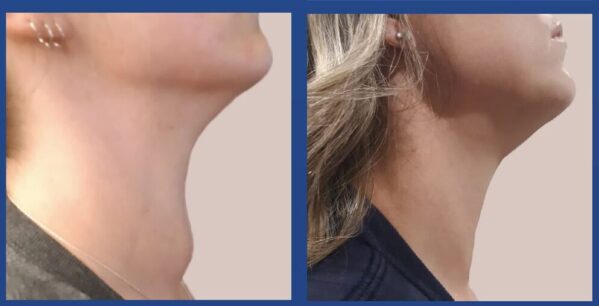 Thyroid Radiofrequency Before & After