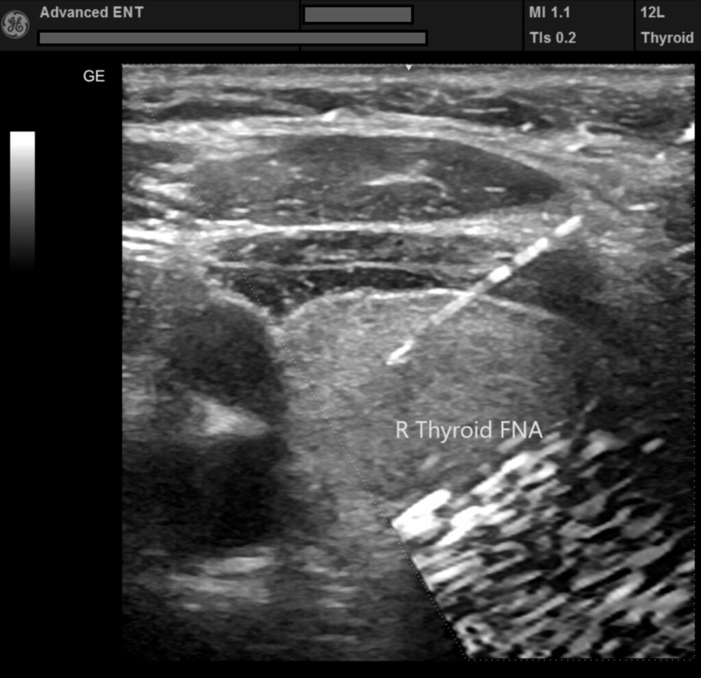 Thyroid nodule guided biopsy and radiofrequency ablation